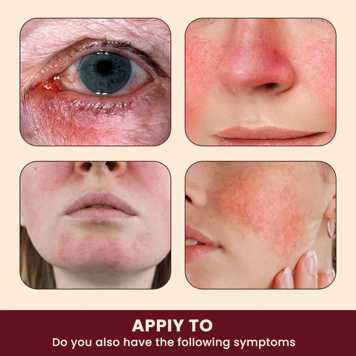 Sumifun Rosacea Relief Cream