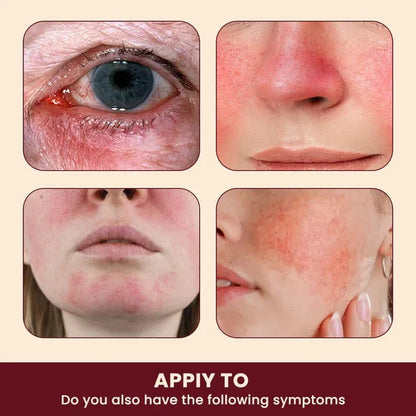 Sumifun Rosacea Relief Cream